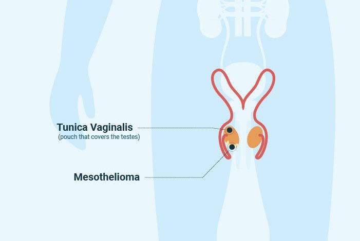 Cancer of The Testicles Called Testicular Mesothelioma