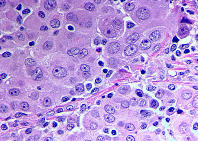 Epithelial Mesothelioma and it’s Developmental Stages and Treatments