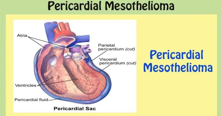 Pericardial Mesotheliomas Causes and Possible Treatments