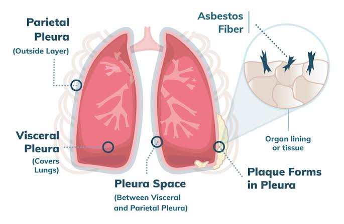 Pleural Mesothelioma and it’s Causative Agents
